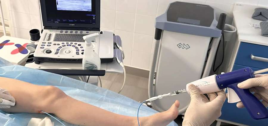 В КЛИНИКЕ РЯЗГМУ ВПЕРВЫЕ ВНЕДРИЛИ ИННОВАЦИОННЫЙ МЕТОД ЛЕЧЕНИЯ ВАРИКОЗА БЕЗ АНЕСТЕЗИИ