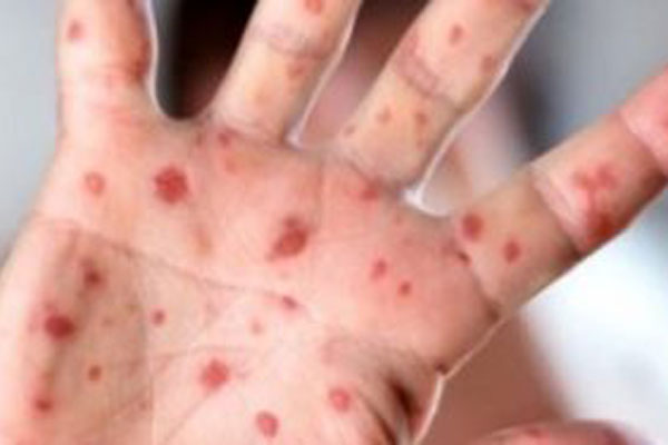 Об организации противоэпидемических мероприятий против кори