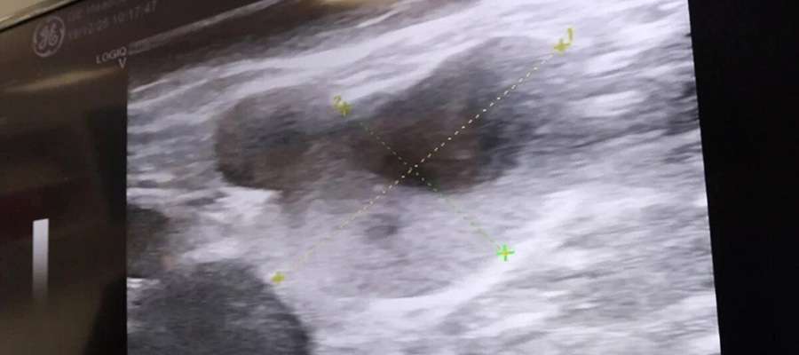 ВАРИКОЗ НЕ ПРОЙДЁТ САМ